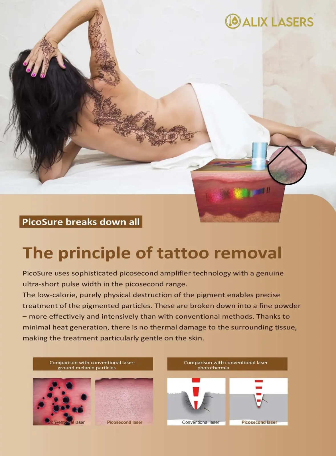 Pico laser tattoo removal – photoacoustic pigment shattering on the skin